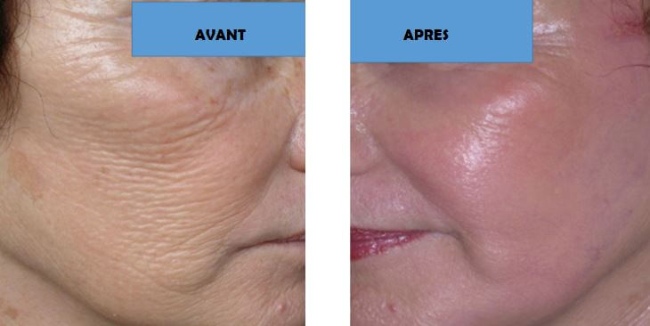 fils tenseurs visage photos. dernieres techniques rajeunissement visage 2019 per le meilleur chirurgien esthetique france